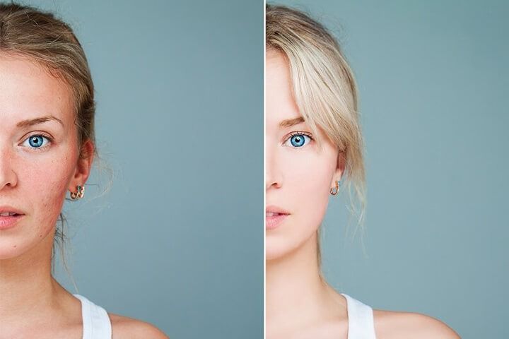 Considering Acne Scar Treatments?