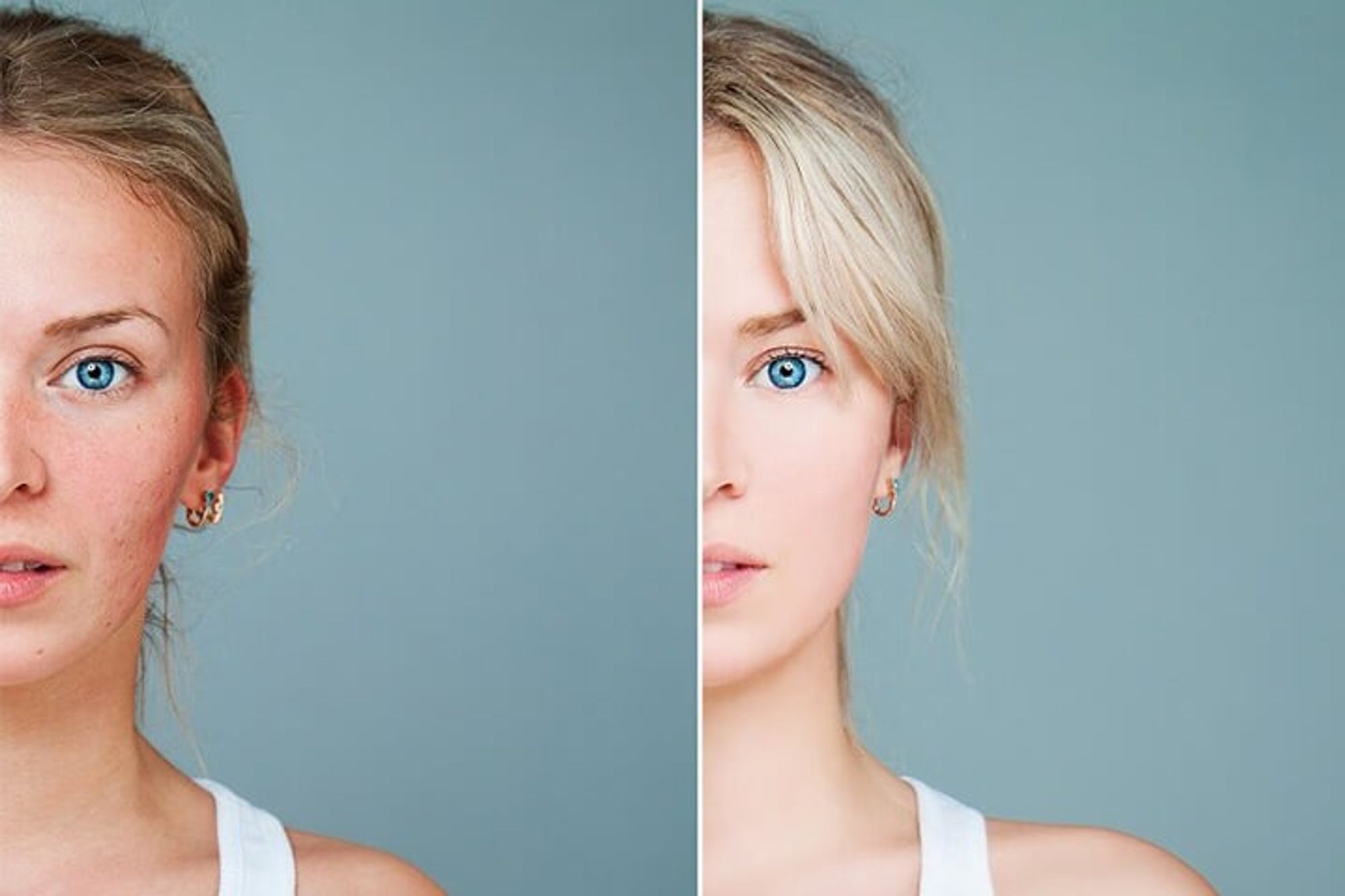 Considering Acne Scar Treatments?