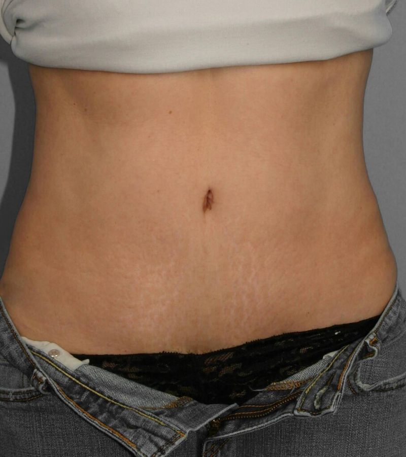 After — Tummy Tuck