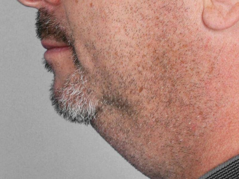 Before — Liposuction