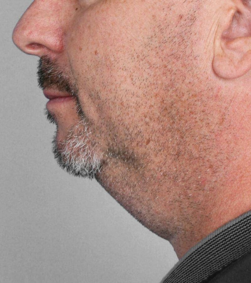 Before — Liposuction
