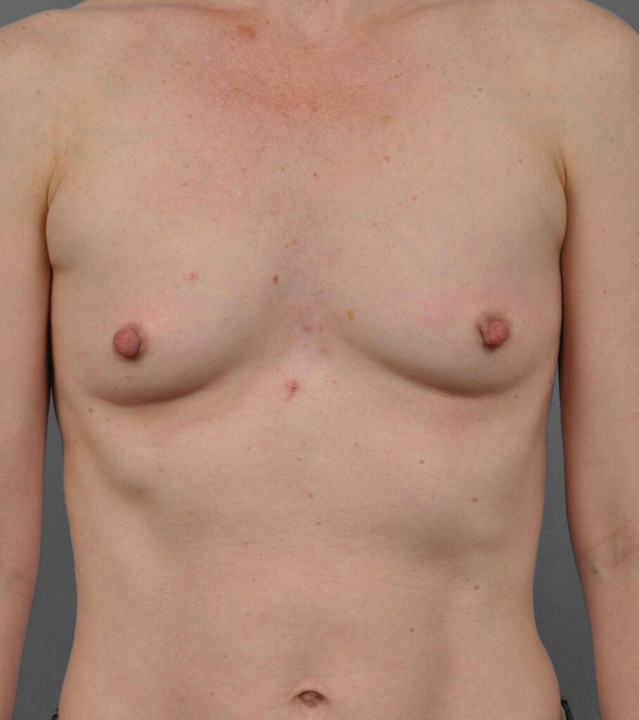 Before — Fat Transfer Breast Augmentation