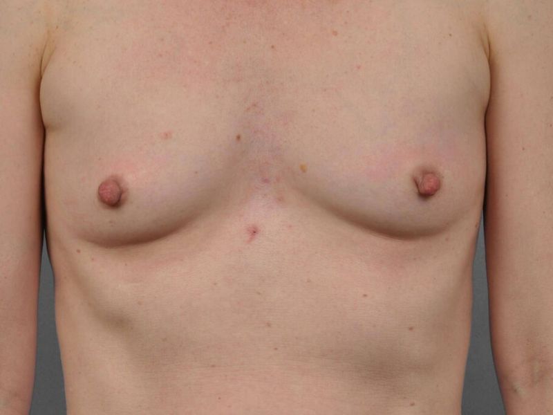 Before — Fat Transfer Breast Augmentation
