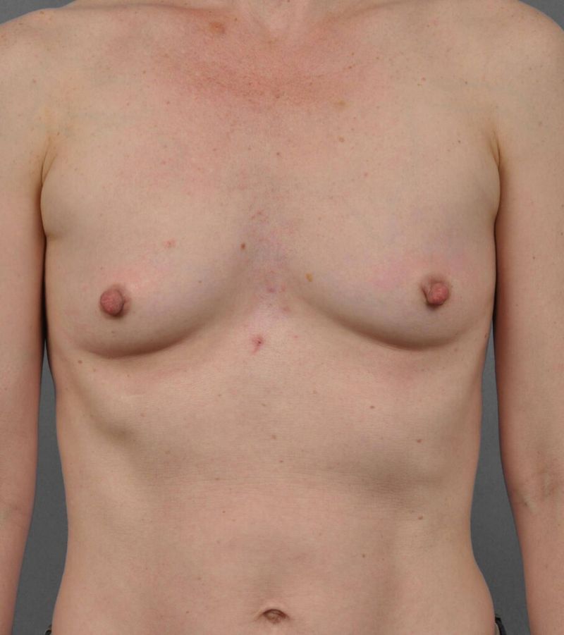 Before — Fat Transfer Breast Augmentation