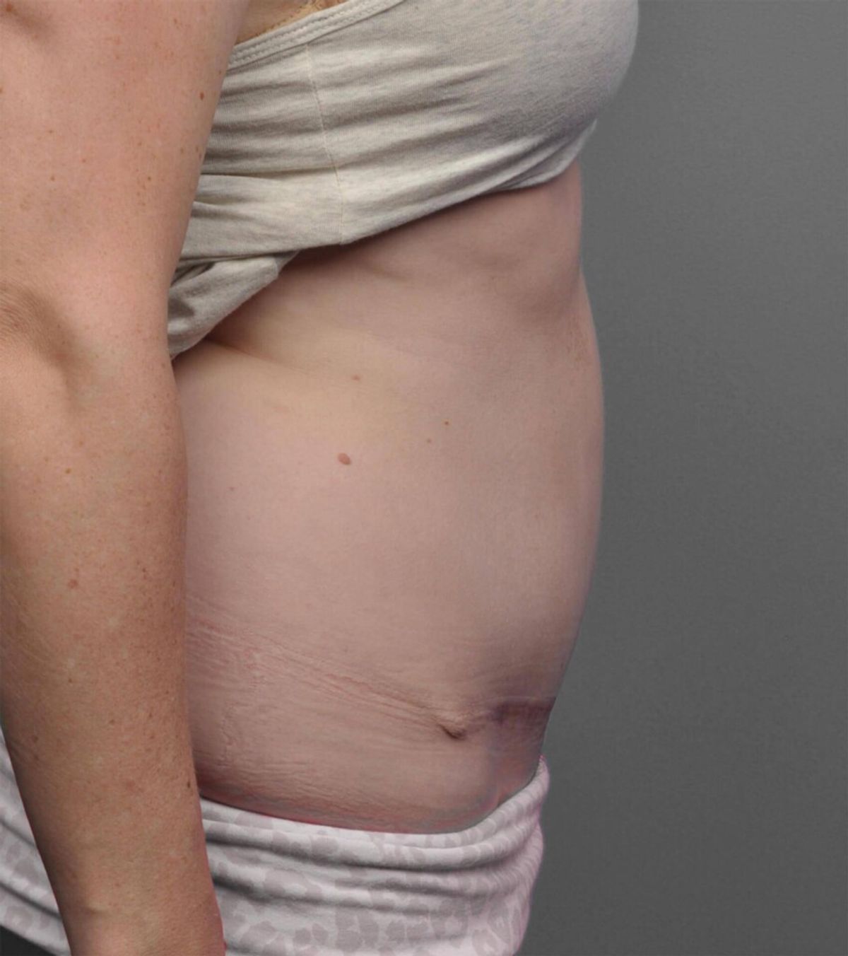 Case 1701 — Oblique after