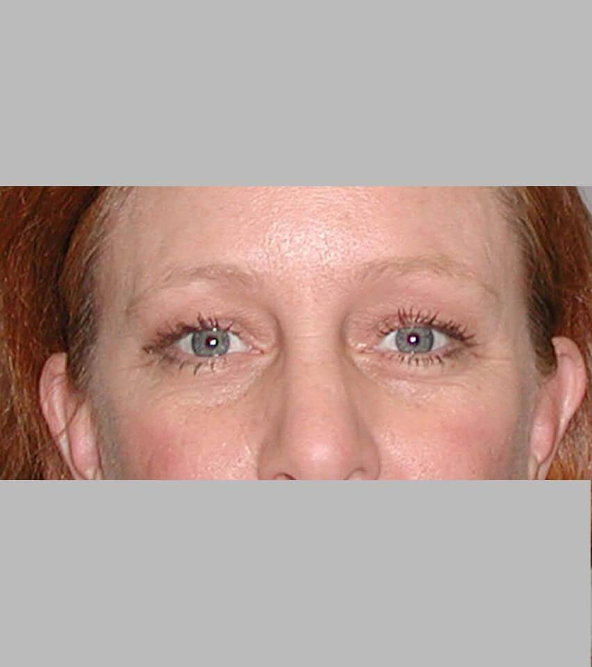 Before — Blepharoplasty