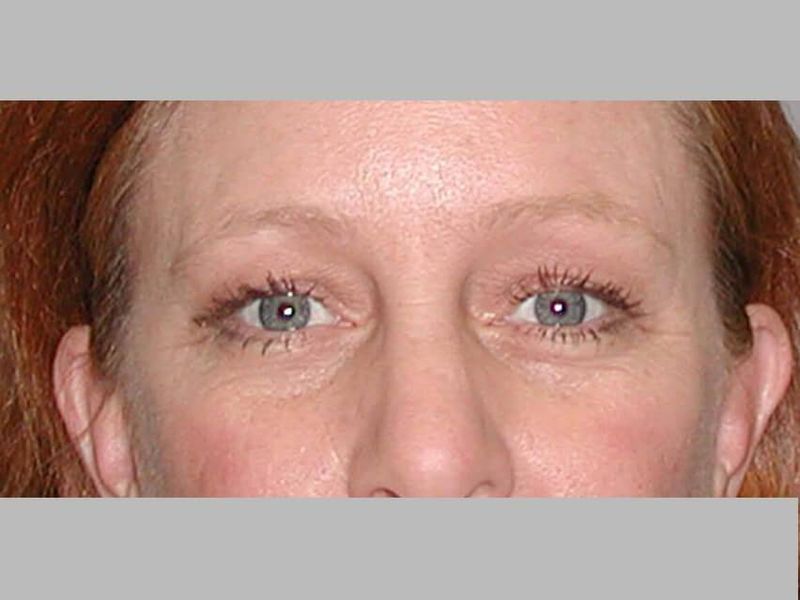 Before — Blepharoplasty