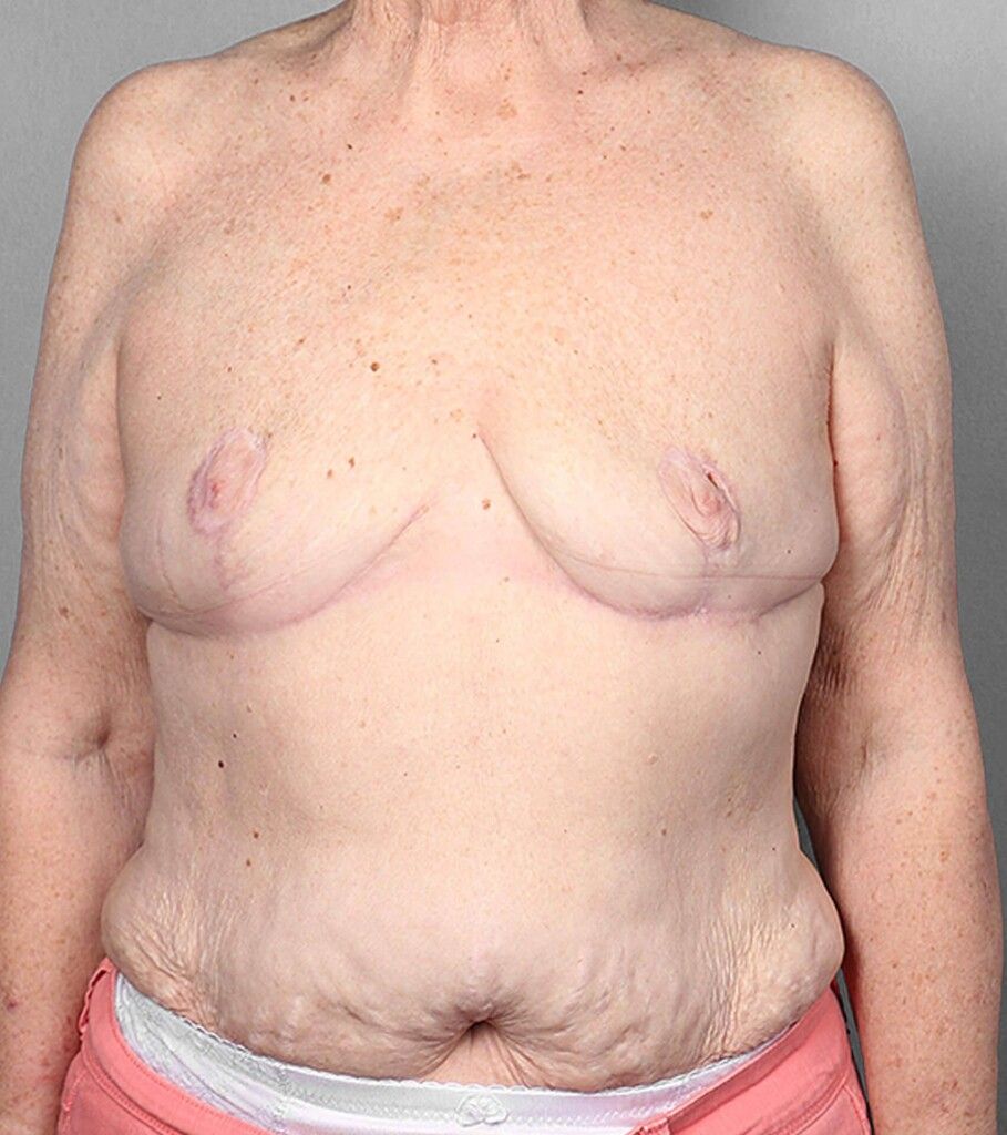 After — SWIM Flap Reconstruction