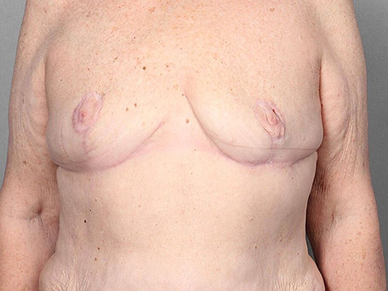 After — SWIM Flap Reconstruction