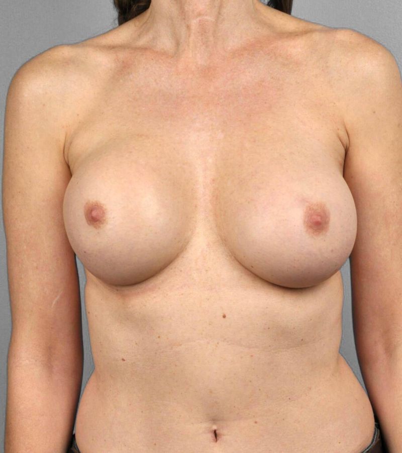 After — Breast Implant Replacement