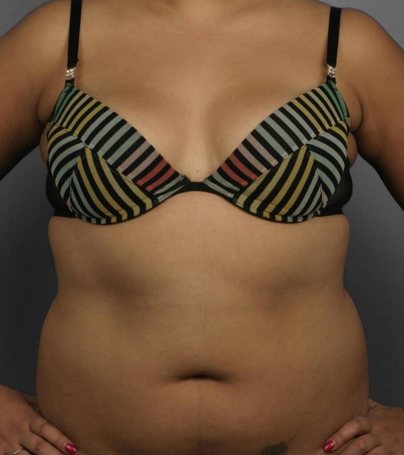 Before — Liposuction