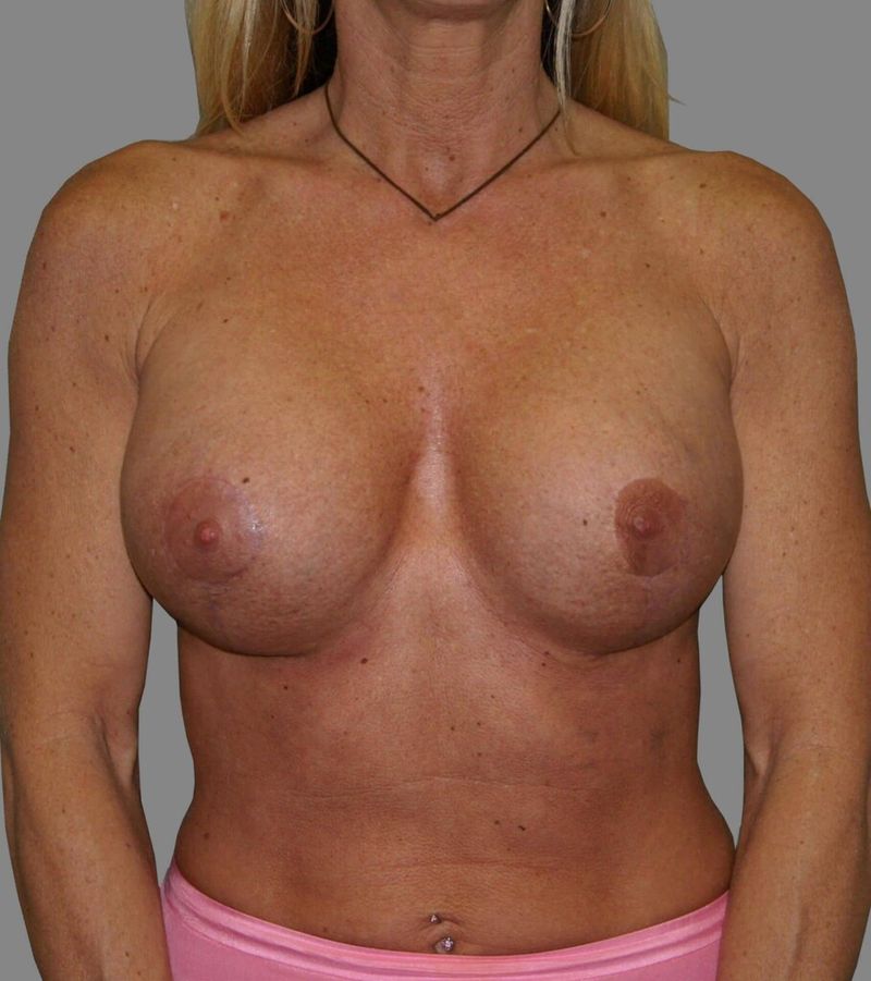 After — Breast Implant Replacement