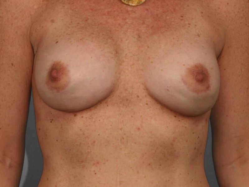After — Breast Reconstruction Revision
