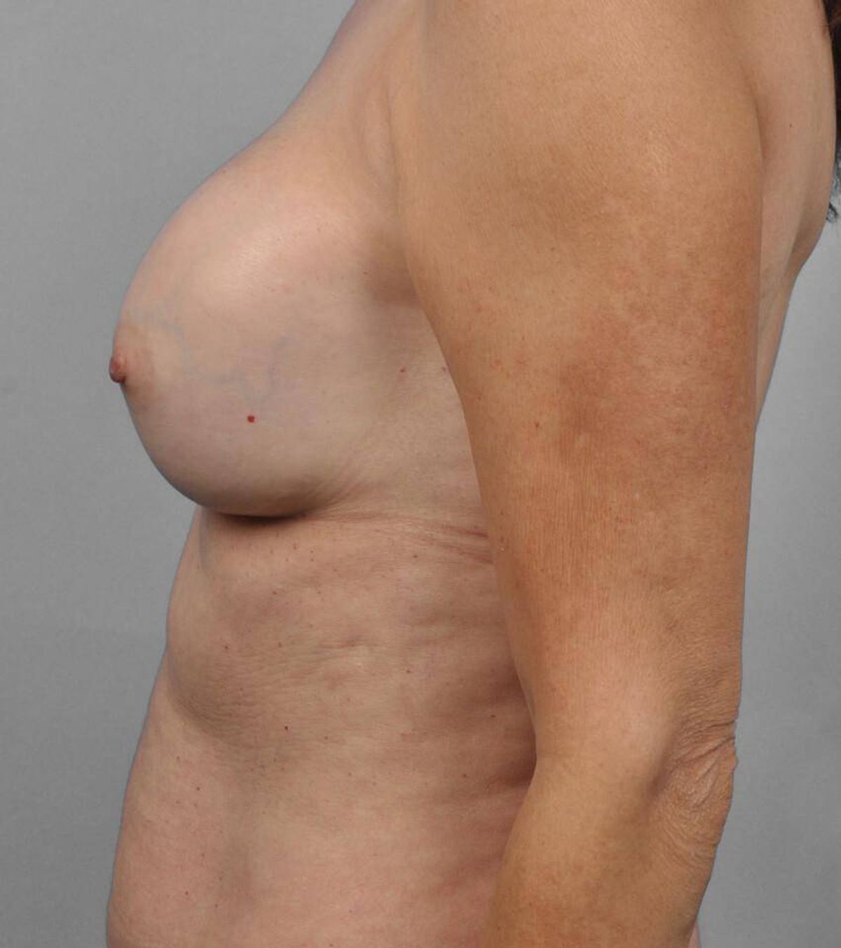 Case 1572 — Oblique after