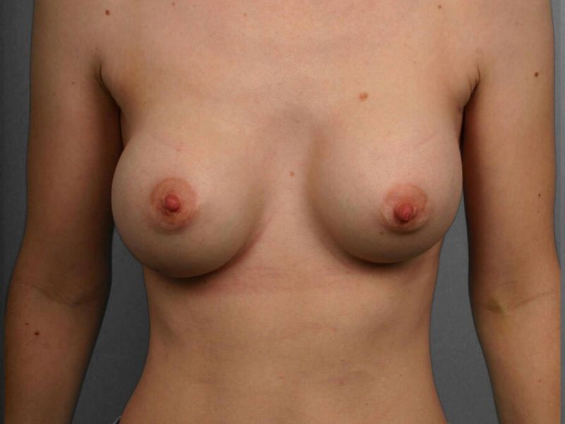 Before — Breast Implant Replacement