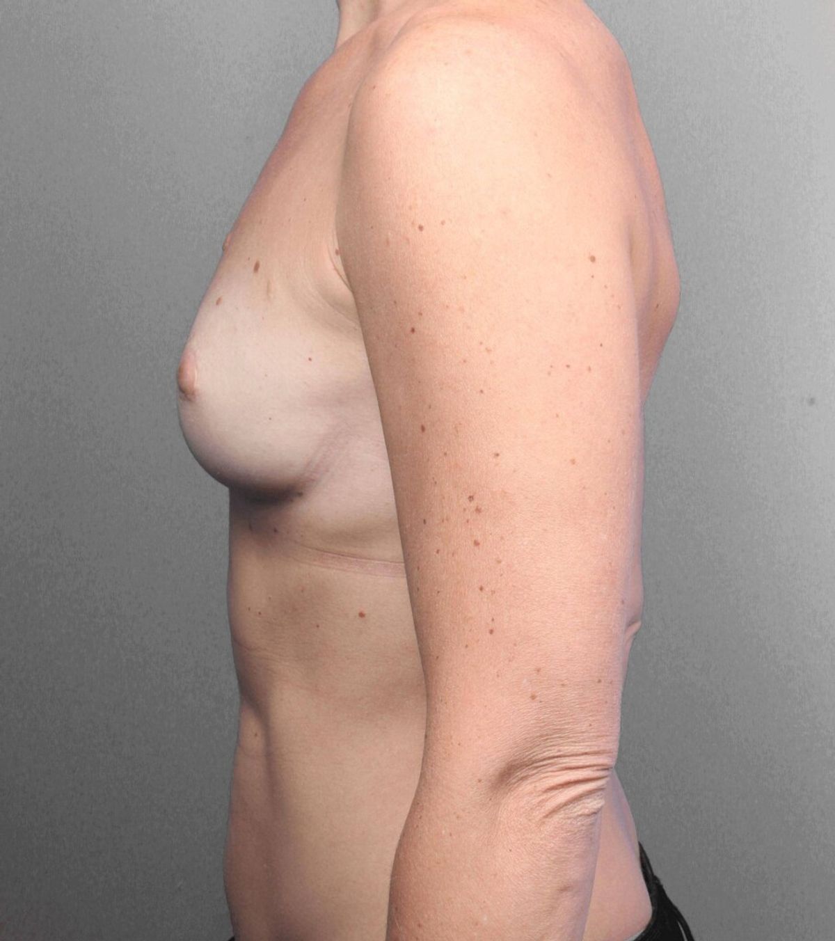 Case 1297 — Oblique before
