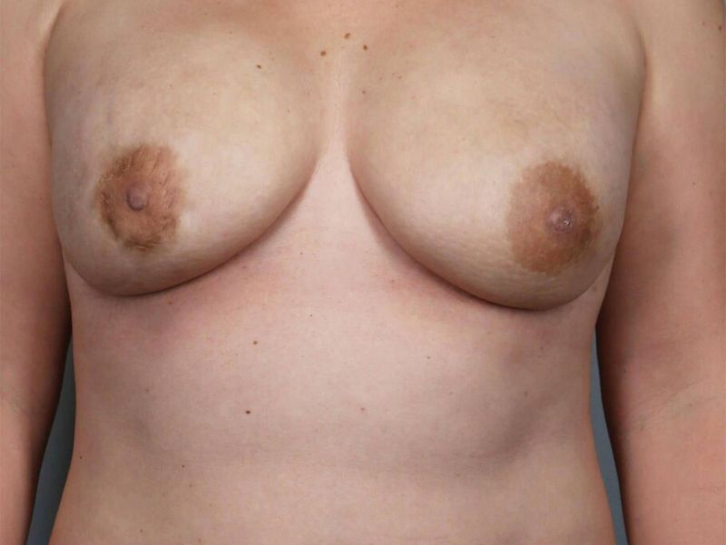 After — Direct-to-Implant Reconstruction
