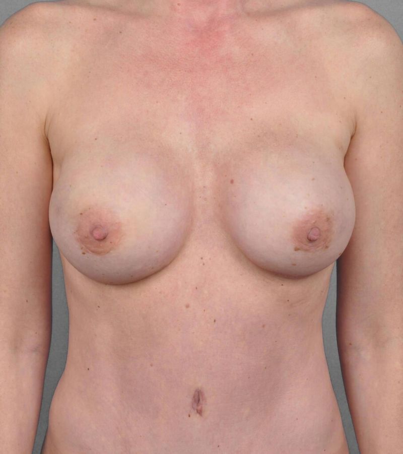 After — Direct-to-Implant Reconstruction