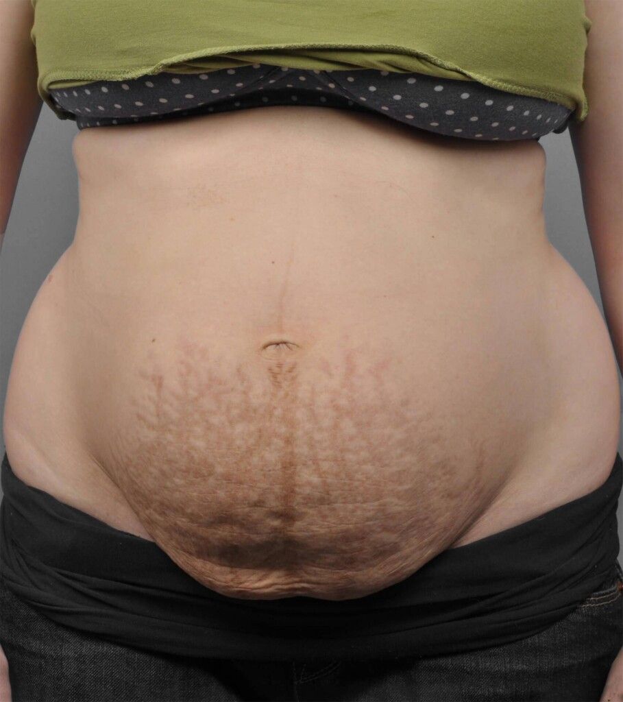 Mommy makeover before photo, tummy tuck with diastasis repair, Santa Monica patient, case 1701
