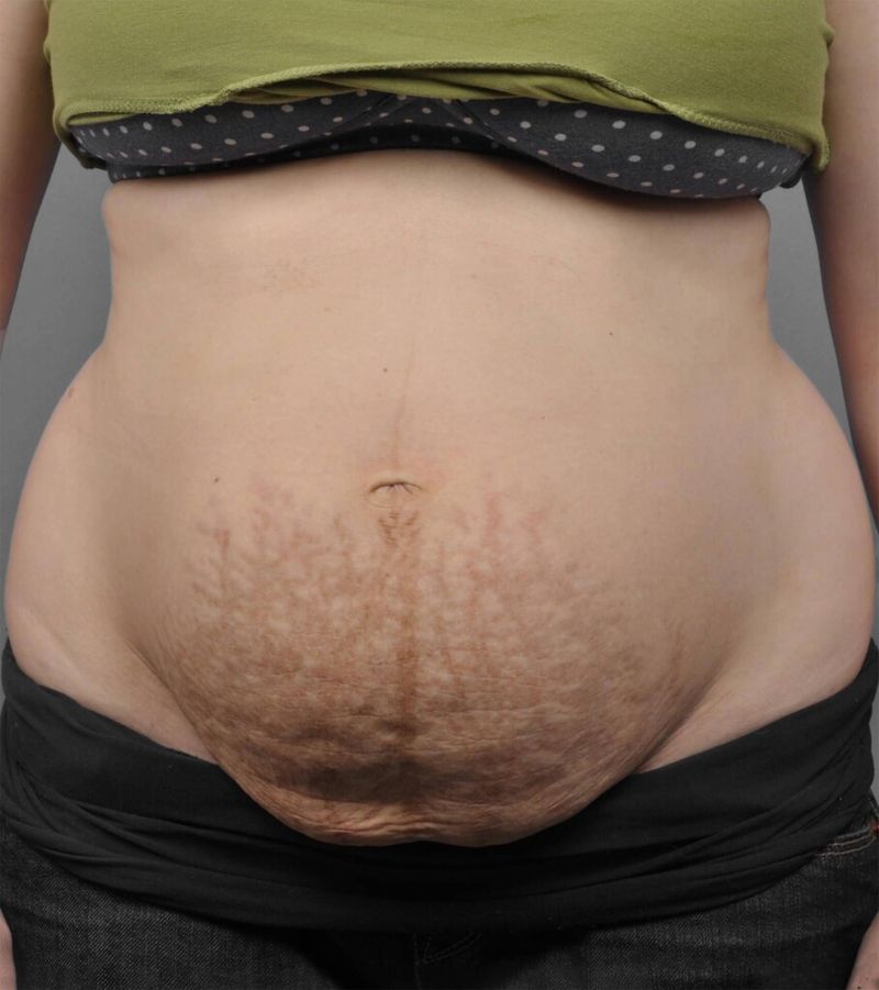 Before — Tummy Tuck