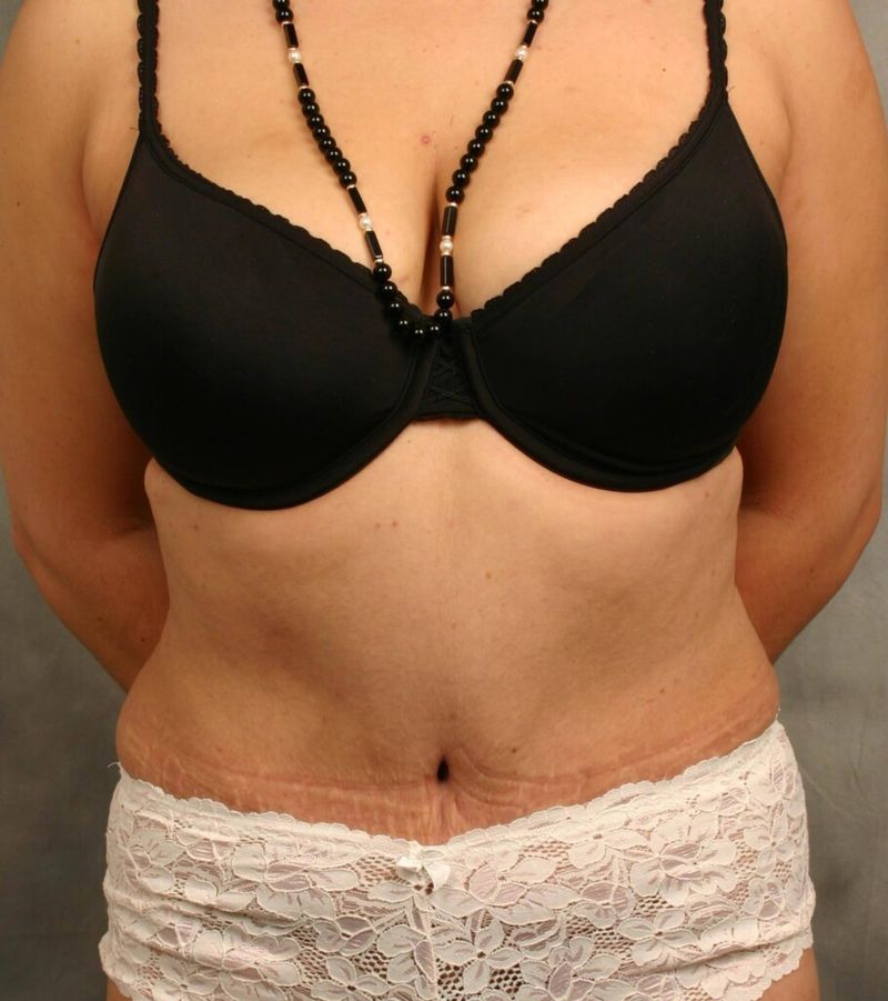 After — Tummy Tuck