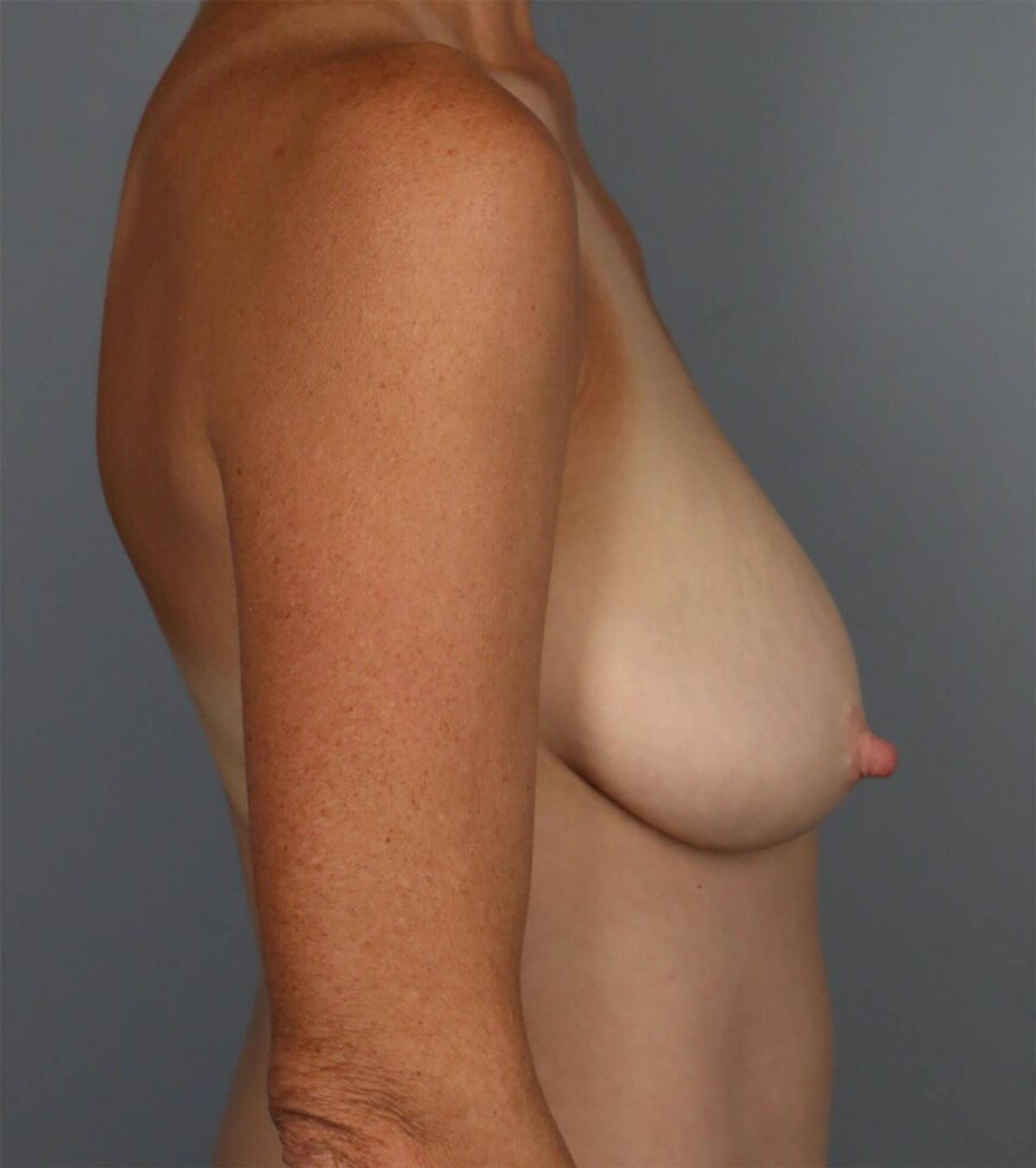 Case 1497 — Oblique before