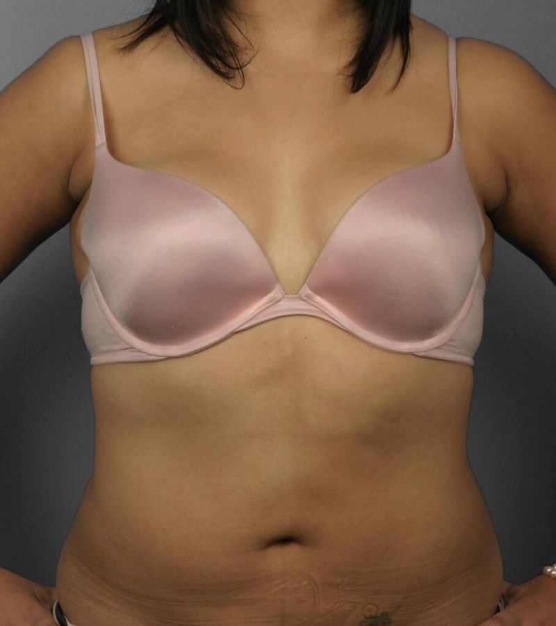 After — Liposuction