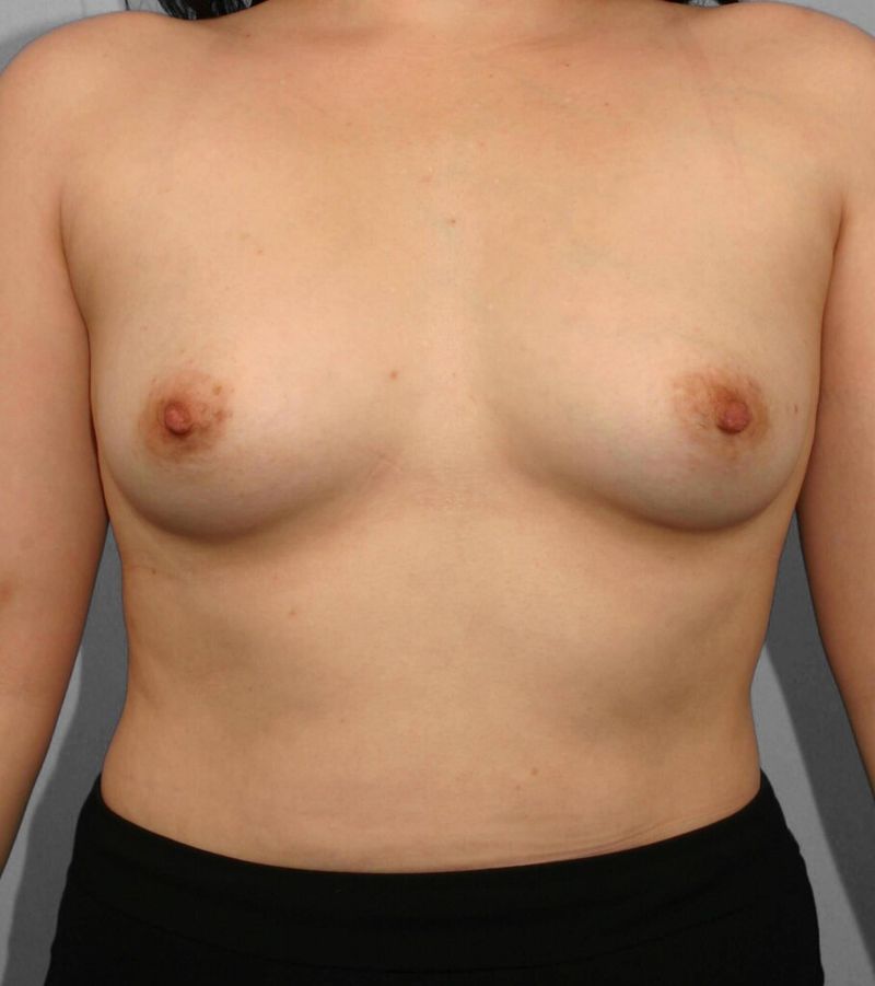Before — Direct-to-Implant Reconstruction