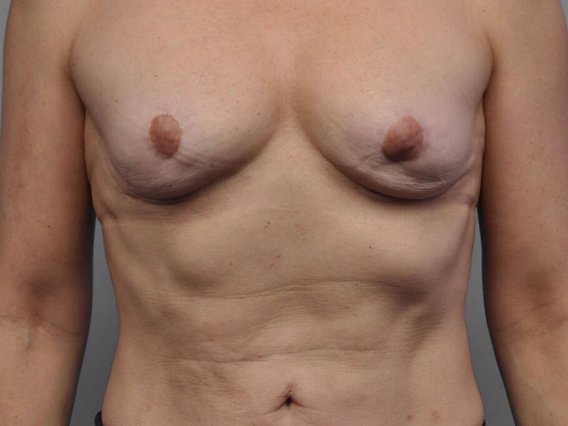 Before — Breast Reconstruction Revision