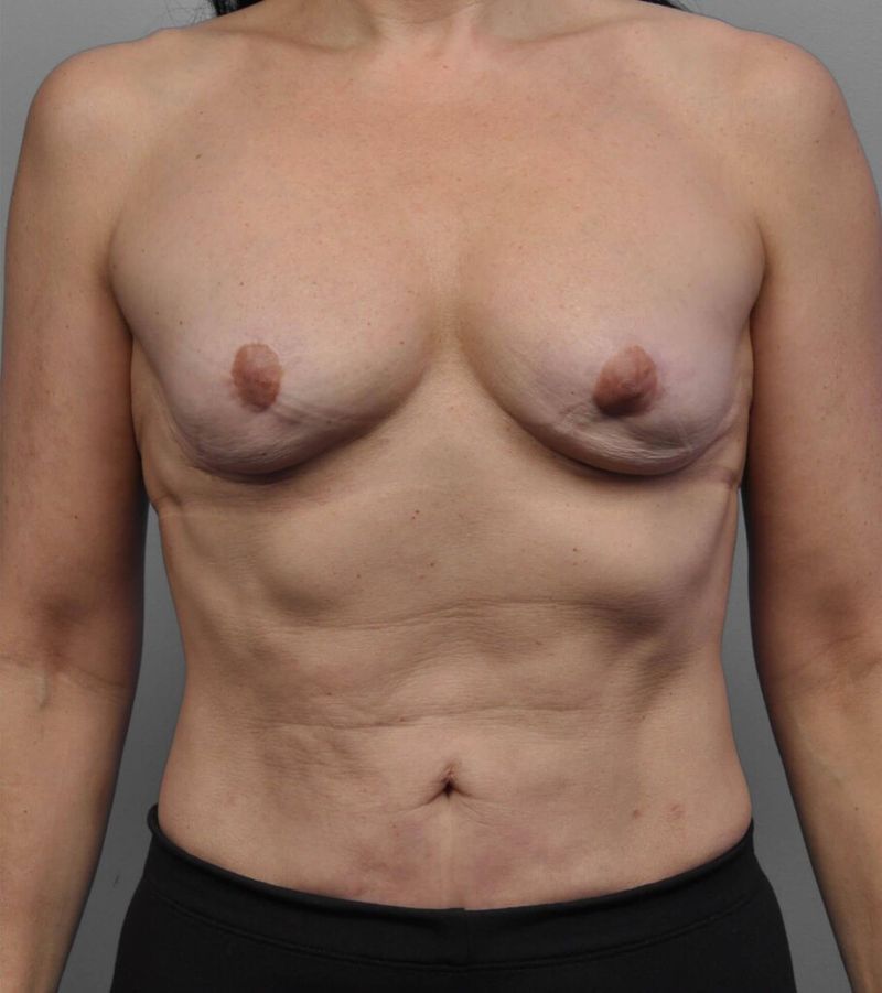 Before — Breast Reconstruction Revision