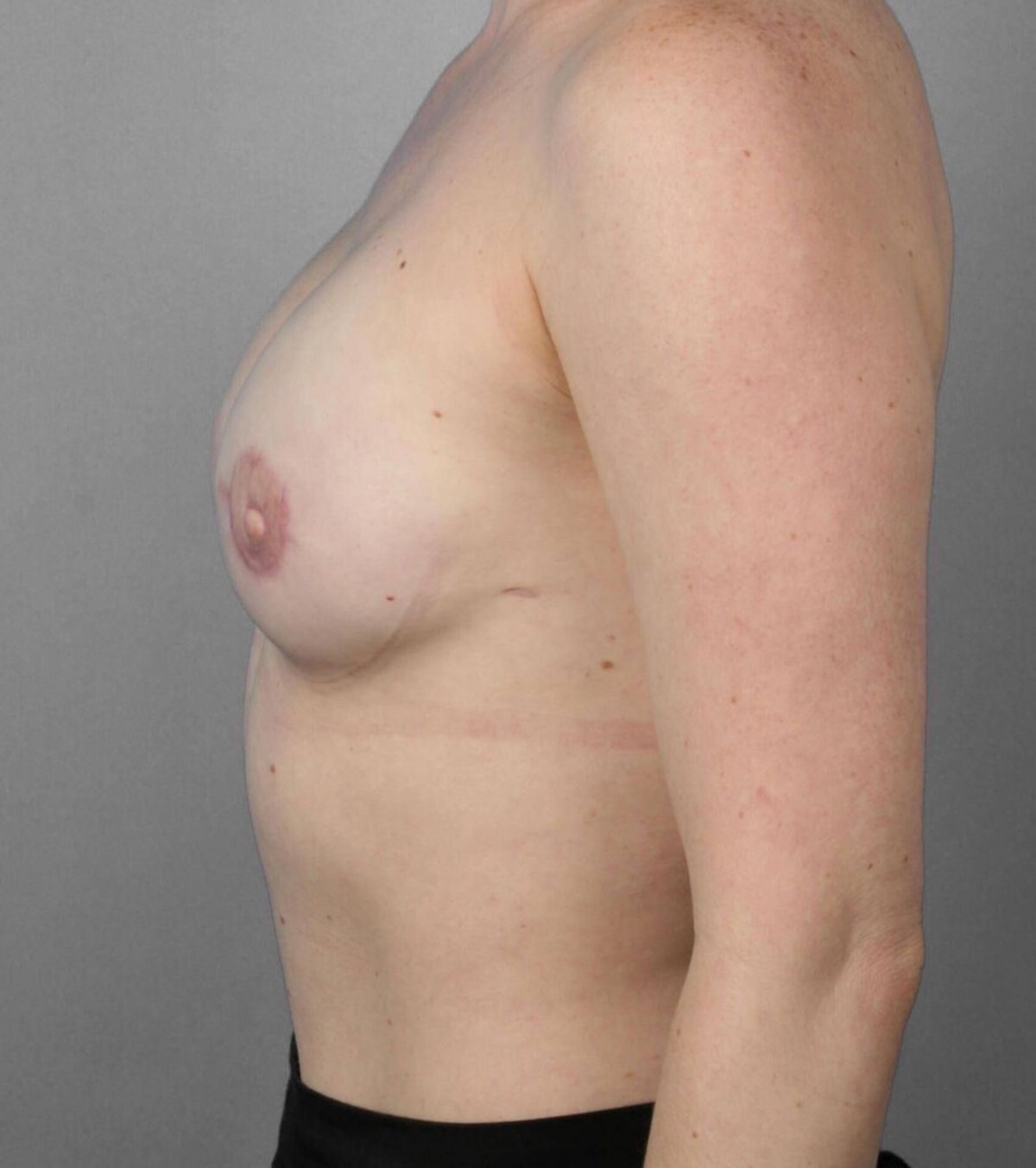 Case 1291 — Oblique after