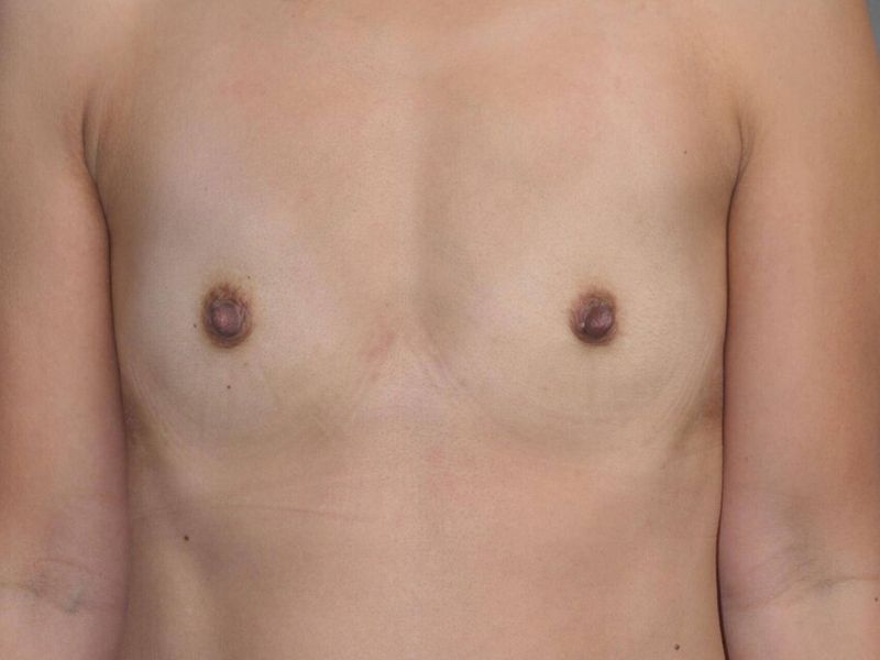 Before — Breast Augmentation