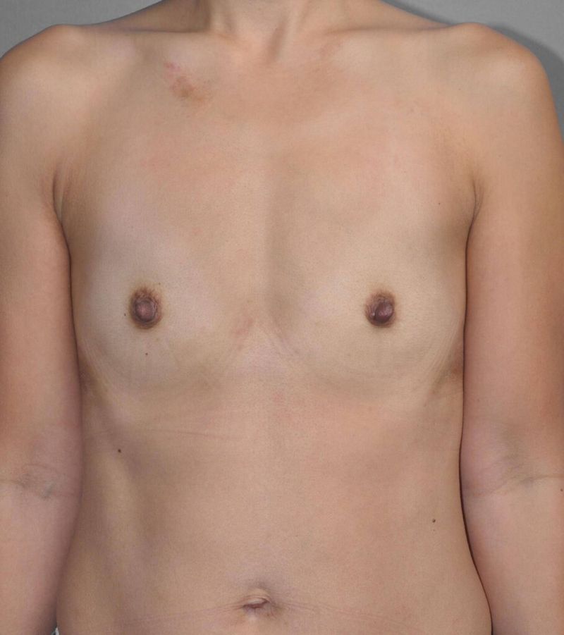 Before — Breast Augmentation
