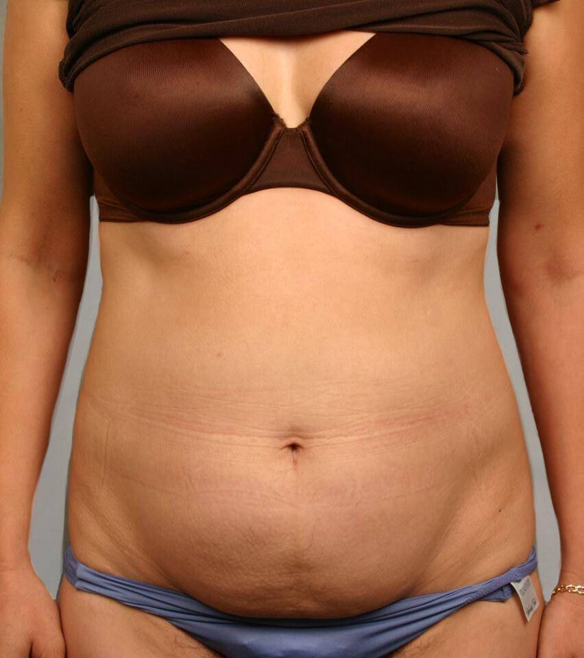 Before — Liposuction