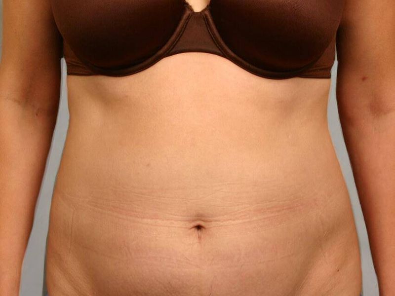Before — Tummy Tuck