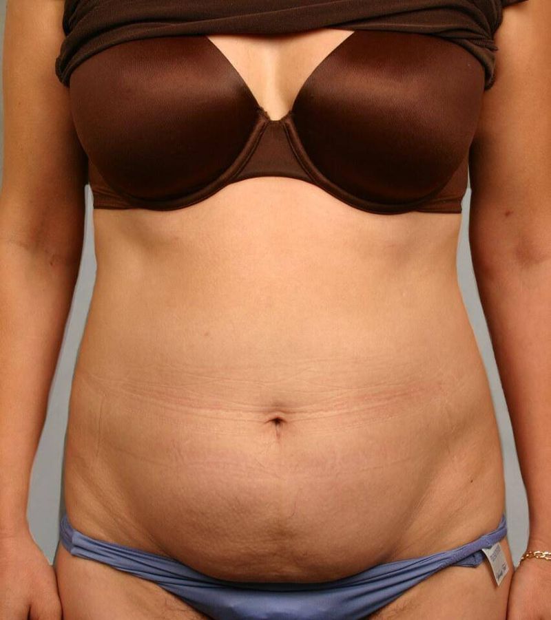 Before — Liposuction