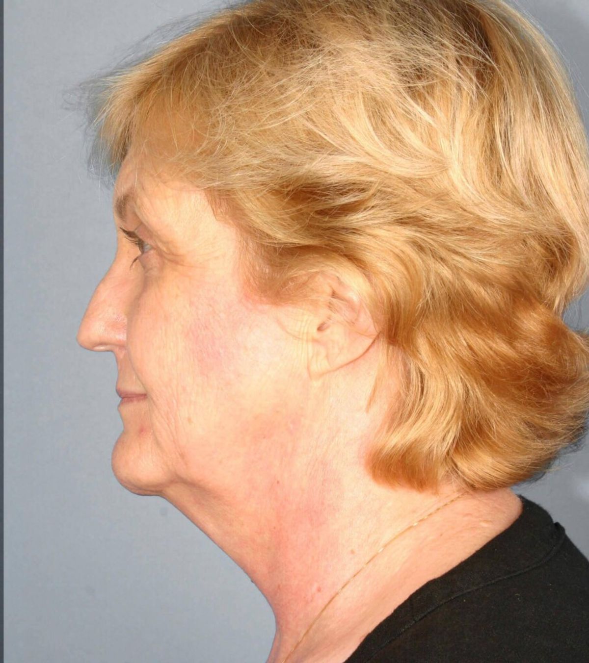 Case 1781 — Oblique before