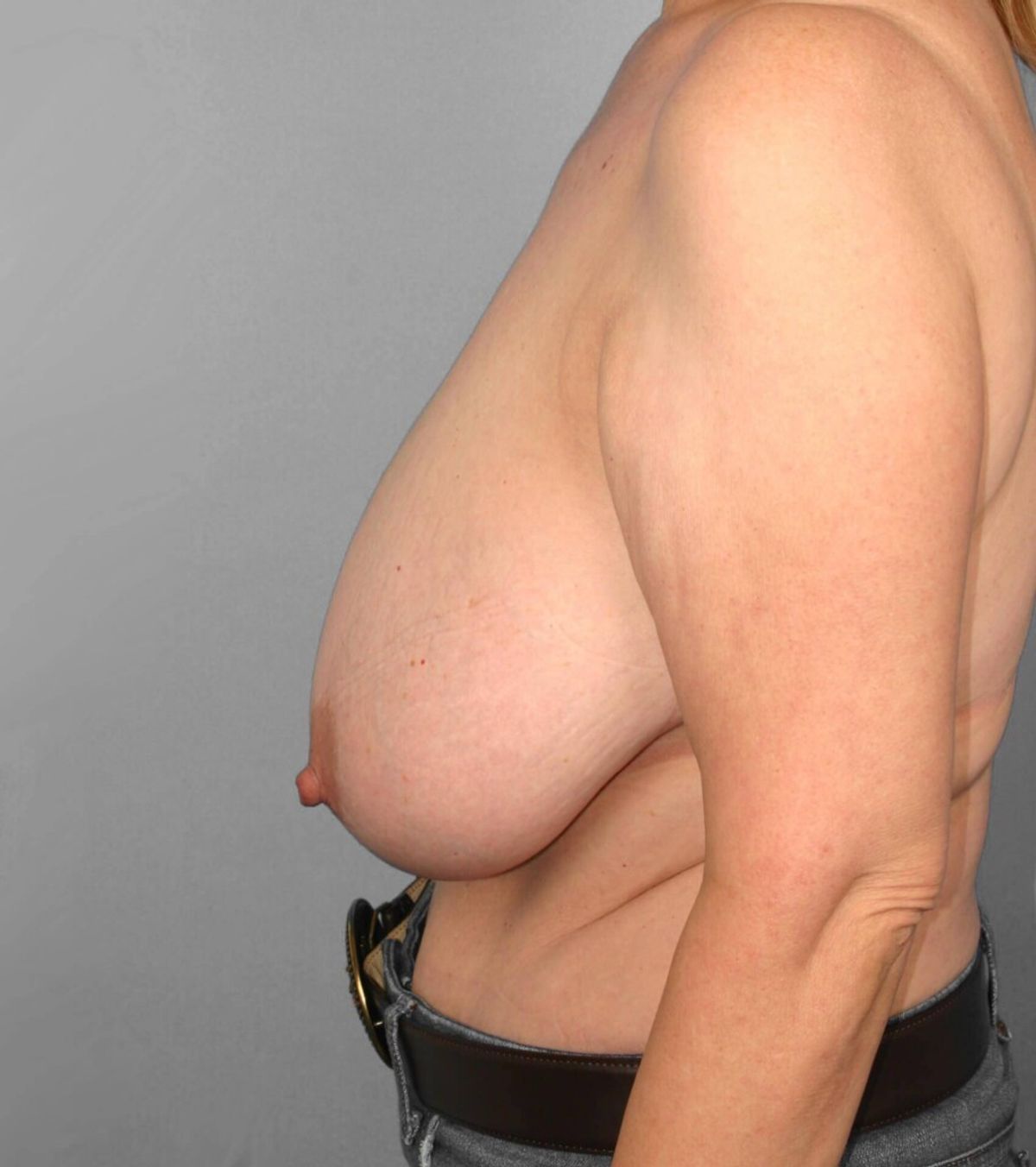 Case 1617 — Oblique before