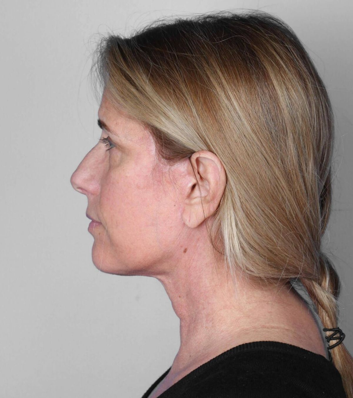 Case 1782 — Oblique after