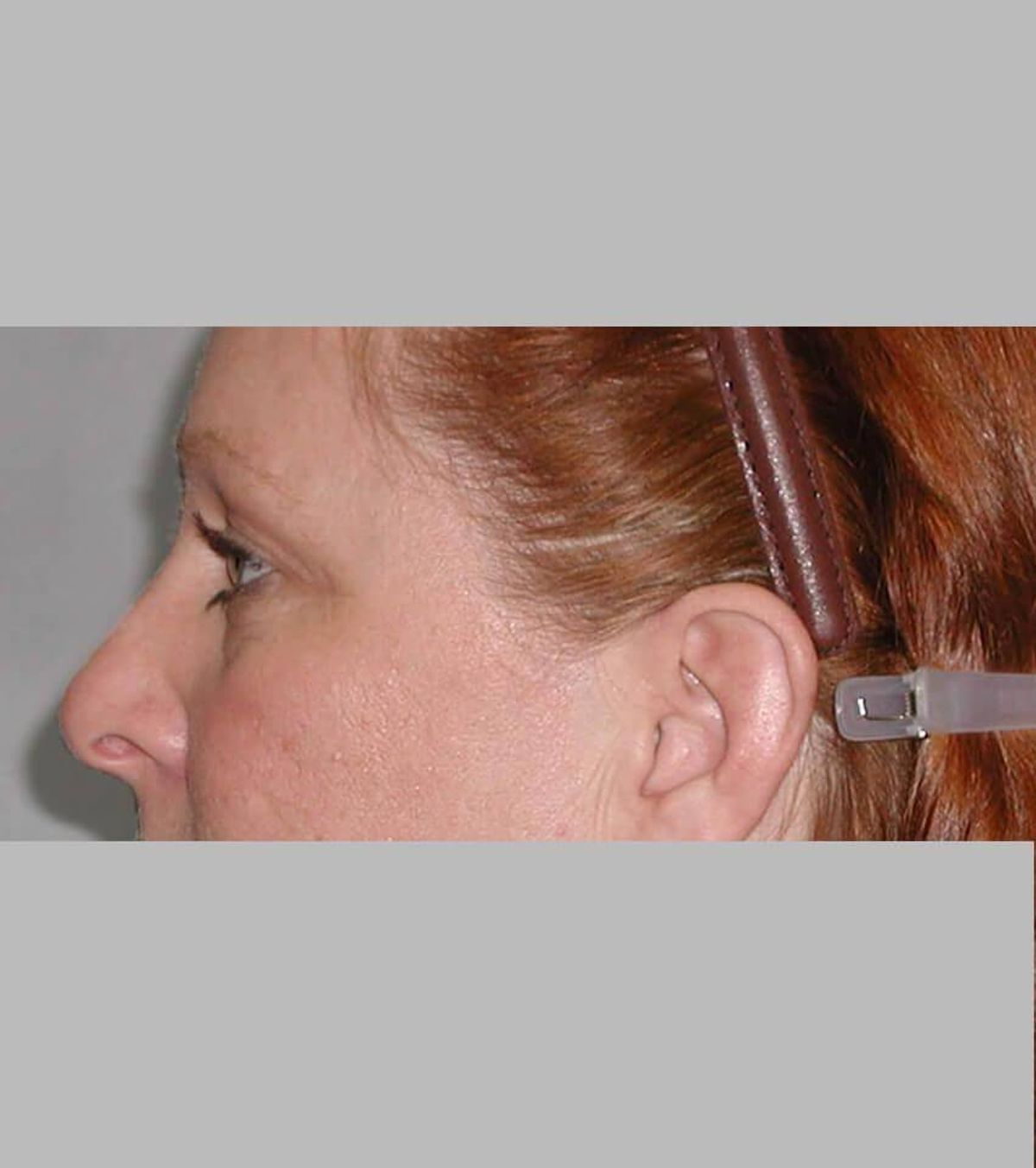 Case 1775 — Oblique before