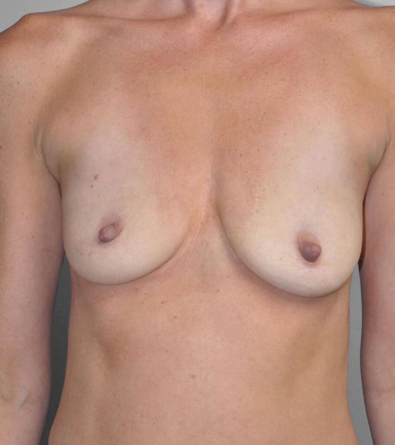 Before — Breast Augmentation