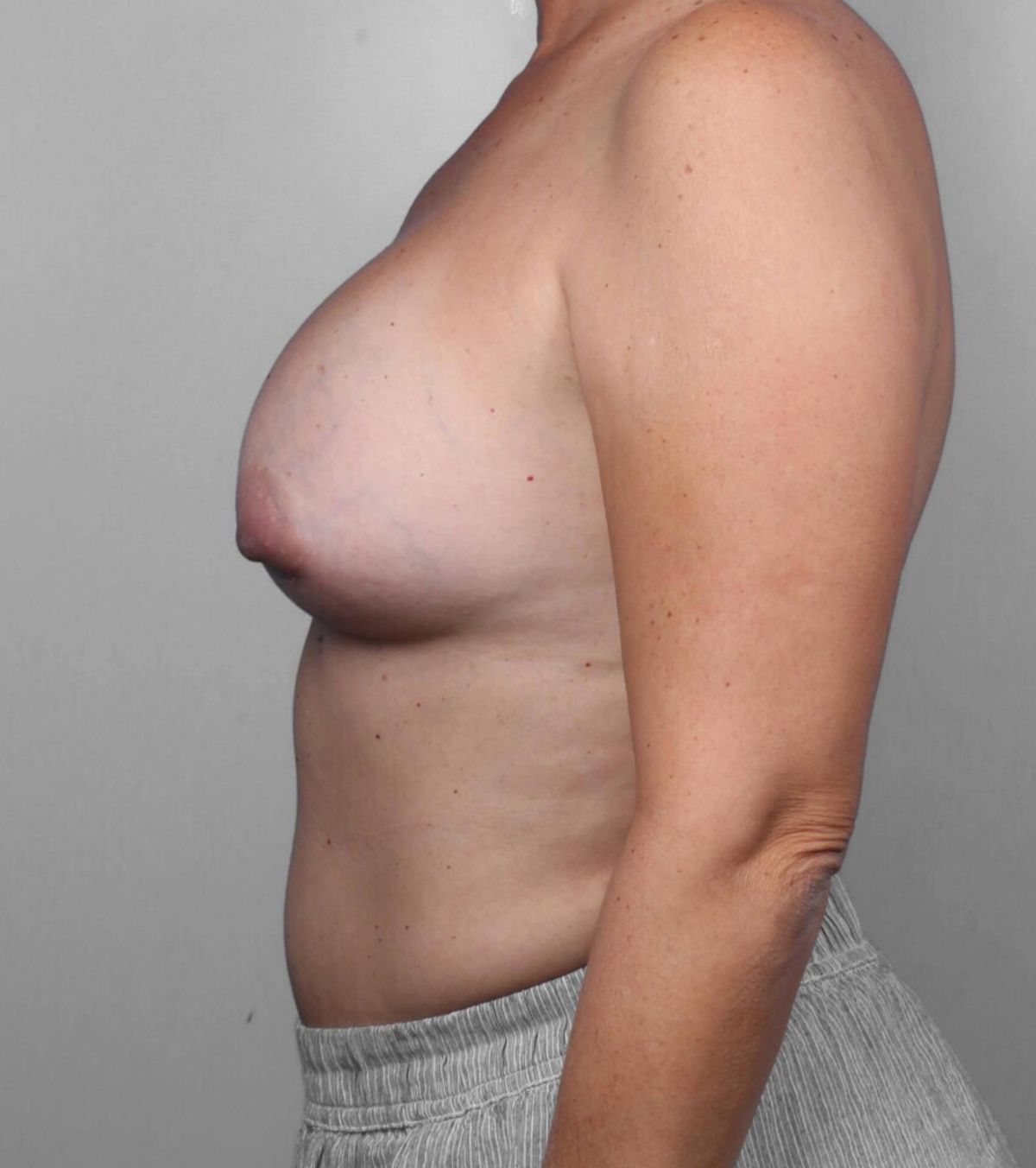 Case 1262 — Oblique before