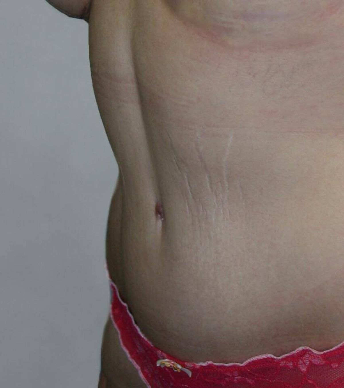 Case 1690 — Side after