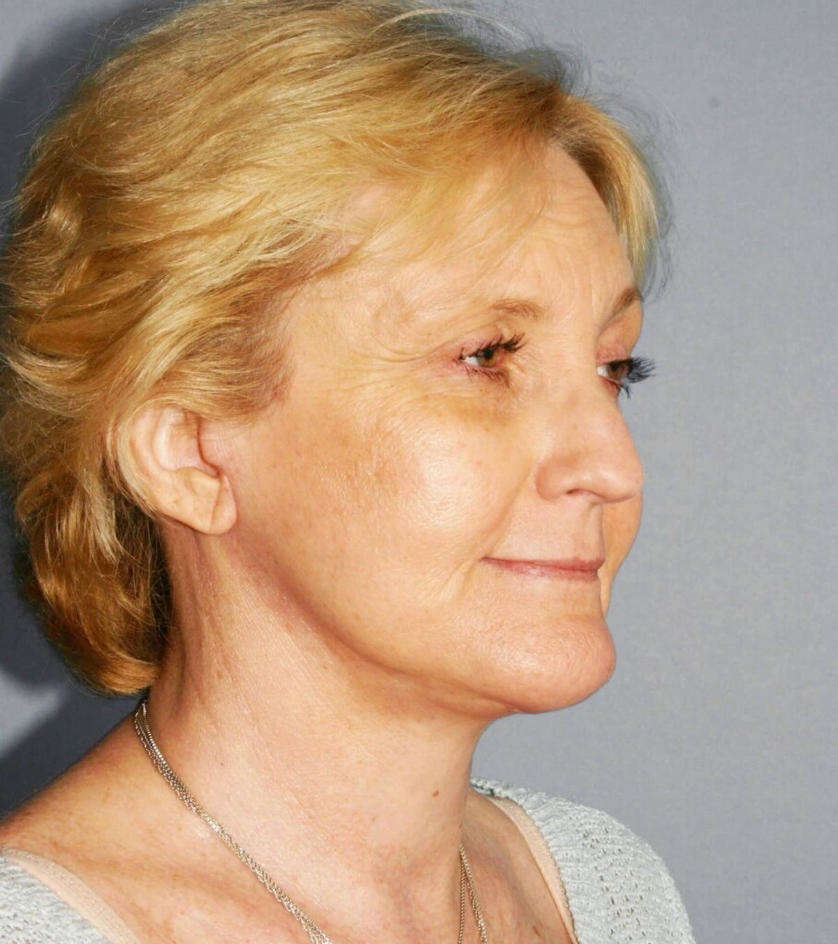 Case 1781 — Side after