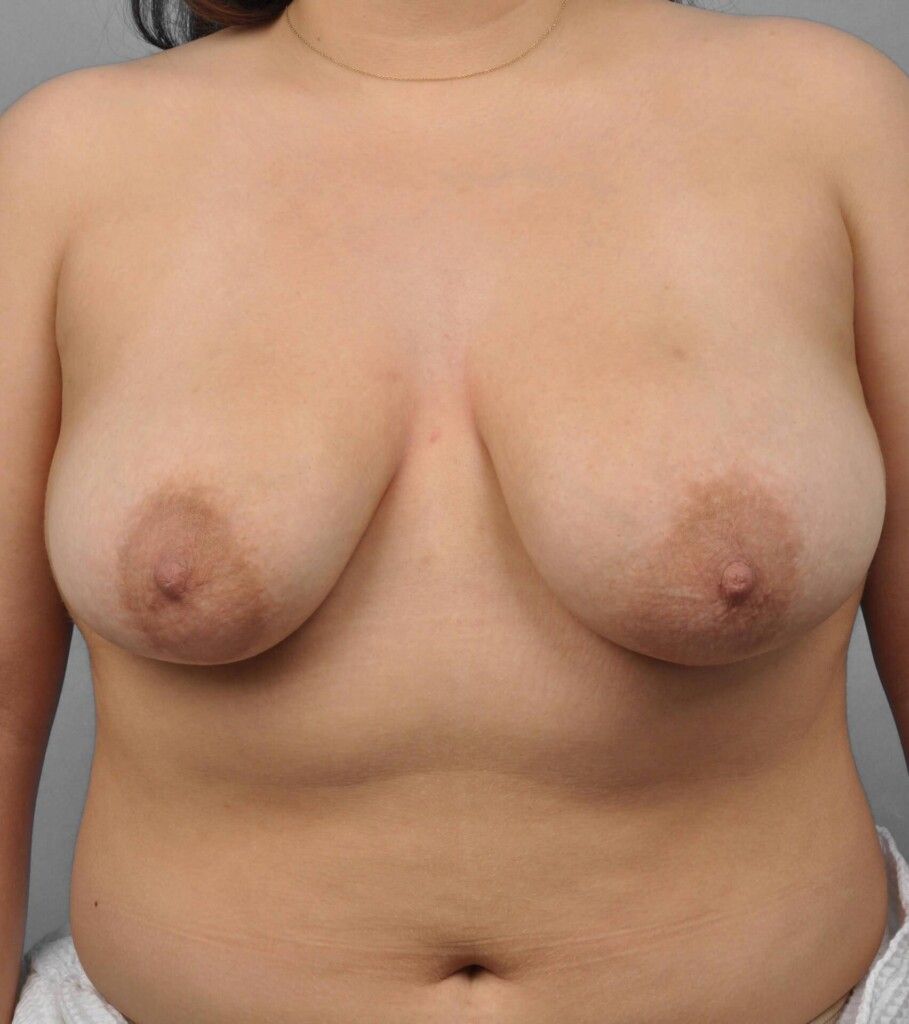 Before — Breast Reduction