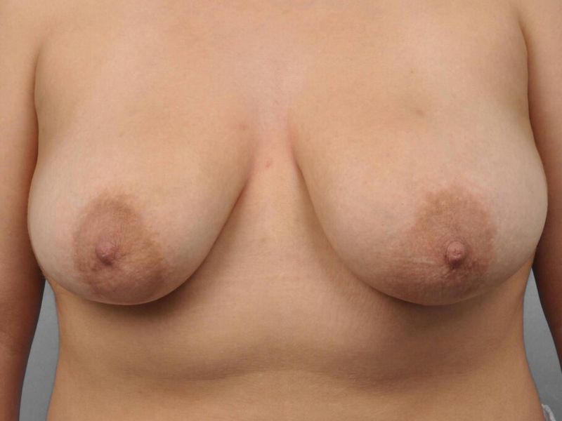 Before — Breast Reduction