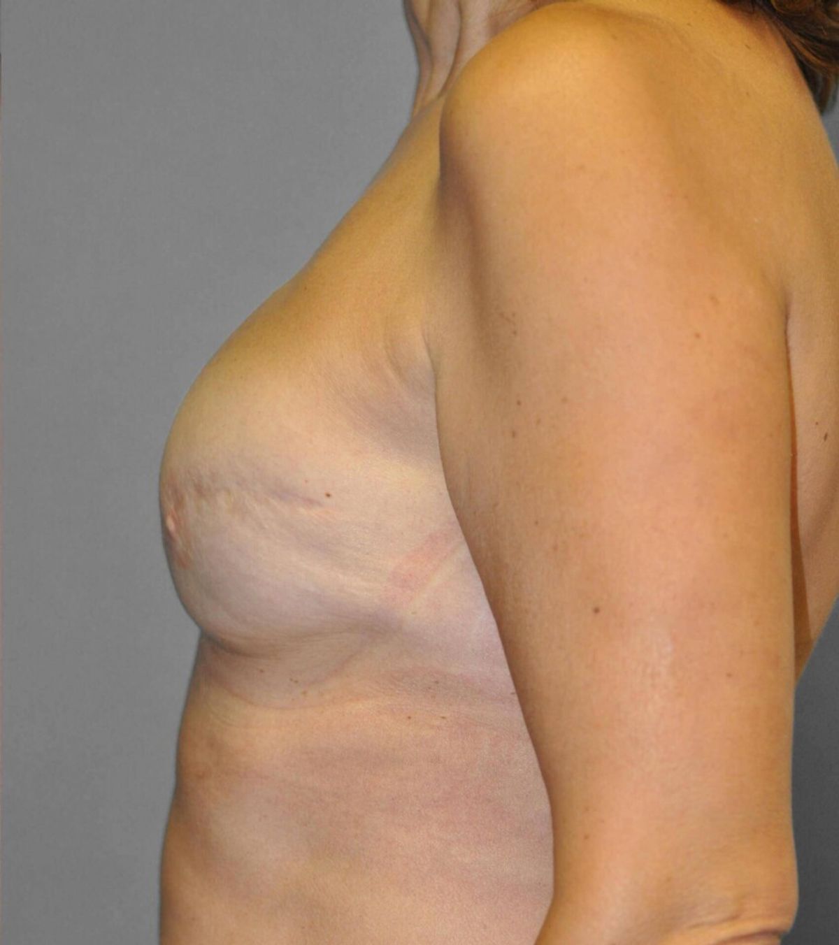 Case 1385 — Oblique before