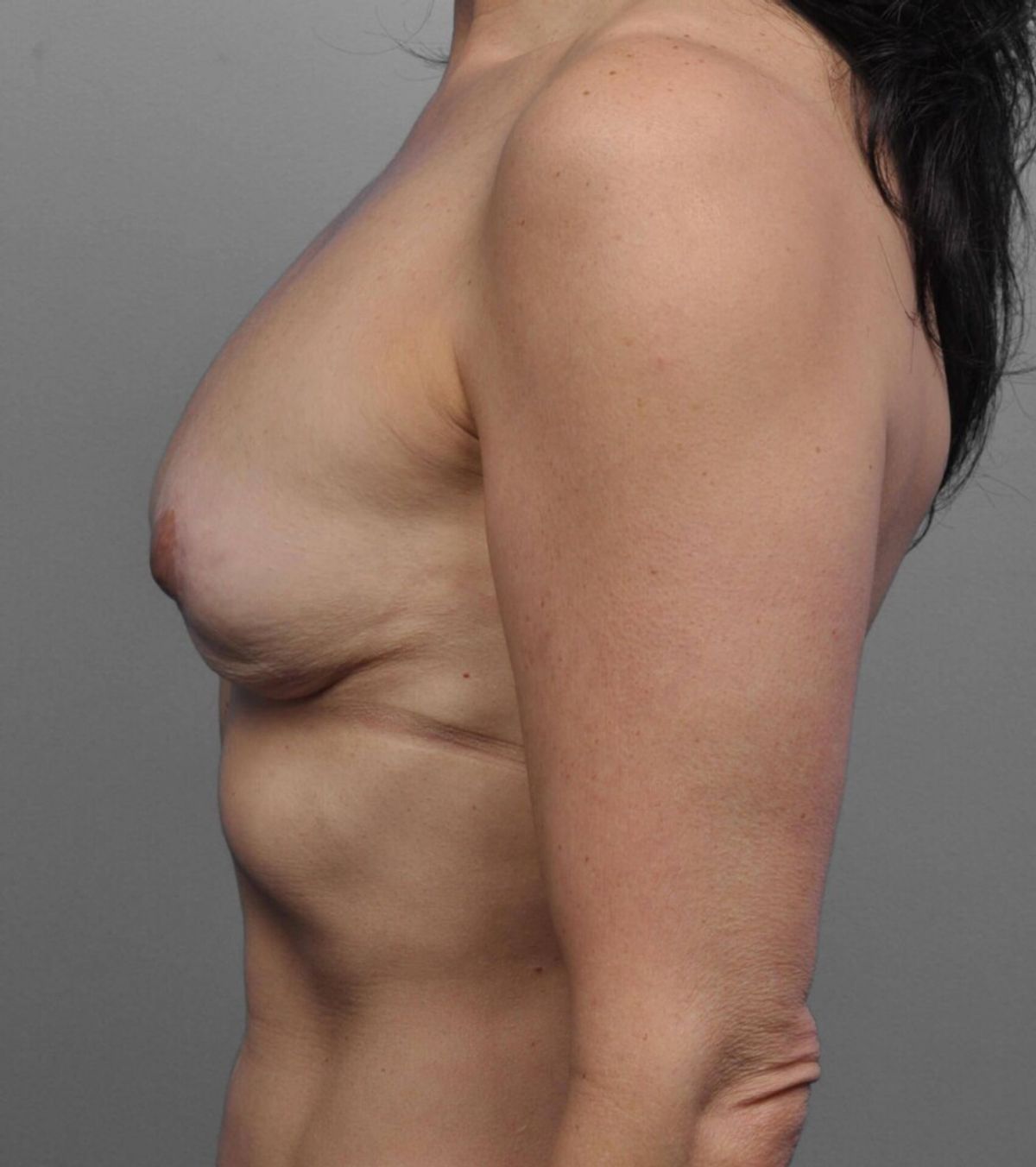 Case 1415 — Oblique before