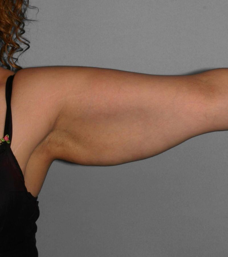 Before — Liposuction