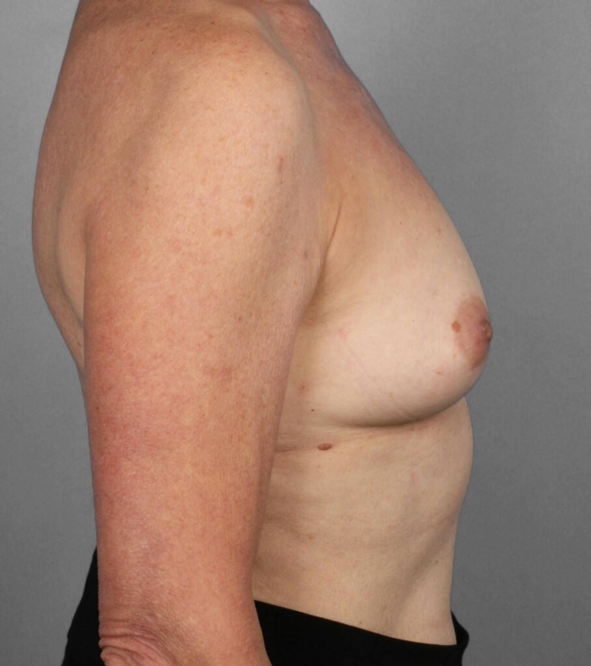 Case 1355 — Oblique before